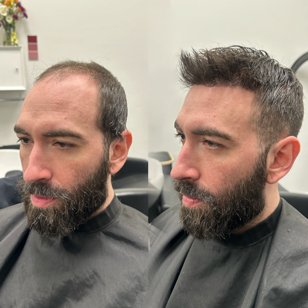 Hair Replacement Hair Systems Men's Hair Units in Arvada Colorado before and after 1