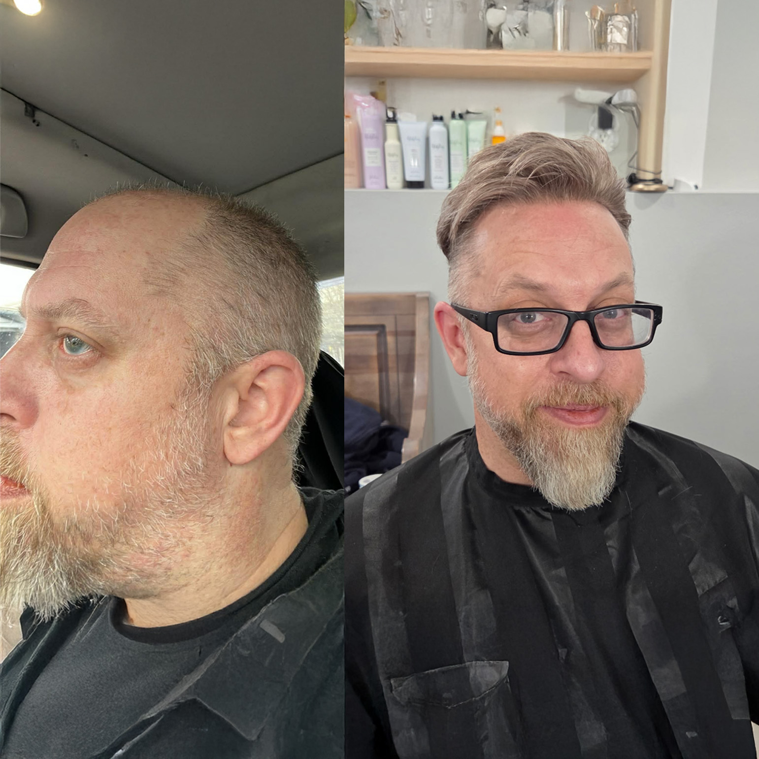 Hair Replacement Hair Systems Men's Hair Units in Arvada Colorado before and after 2